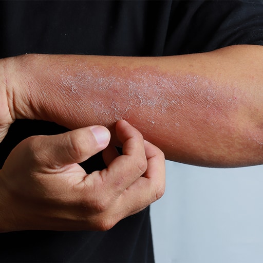 Dermatitis Atópica (también conocida como eccema)